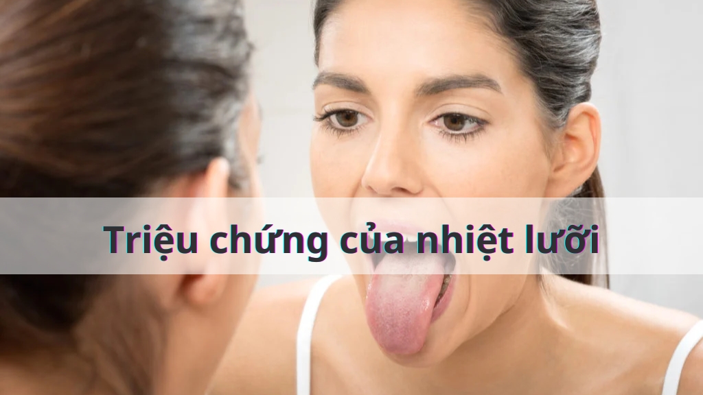 Triệu chứng của nhiệt lưỡi