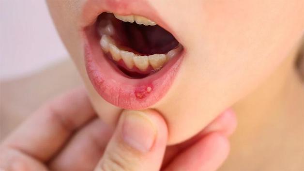 Tình trạng nhiệt miệng ở trẻ gây khó chịu Tình trạng nhiệt miệng ở trẻ gây khó chịu