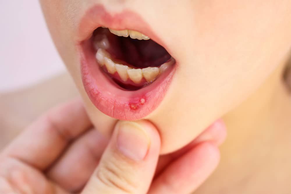 Có nhiều nguyên nhân gây nhiệt miệng Có nhiều nguyên nhân gây nhiệt miệng