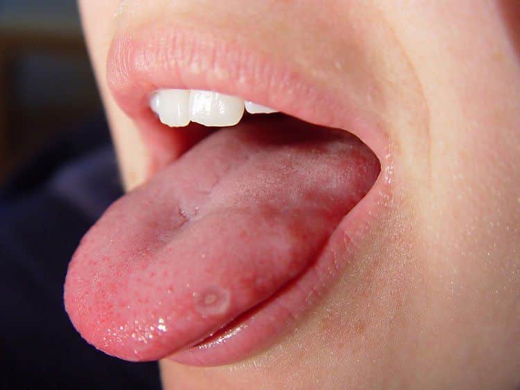 Nhiệt miệng lưỡi là gì? Nhiệt miệng lưỡi là gì?