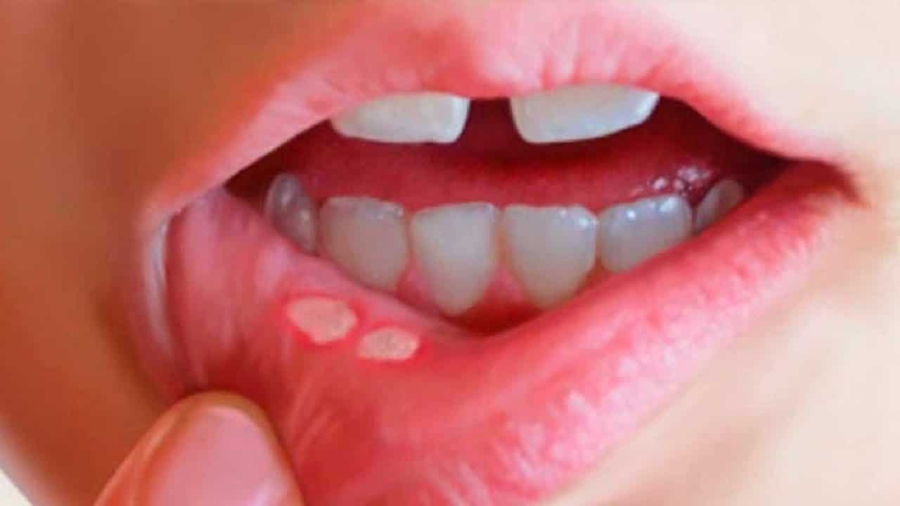 Nhiệt miệng ở trẻ em 2 tuổi nguyên nhân do đâu Nhiệt miệng ở trẻ em 2 tuổi nguyên nhân do đâu