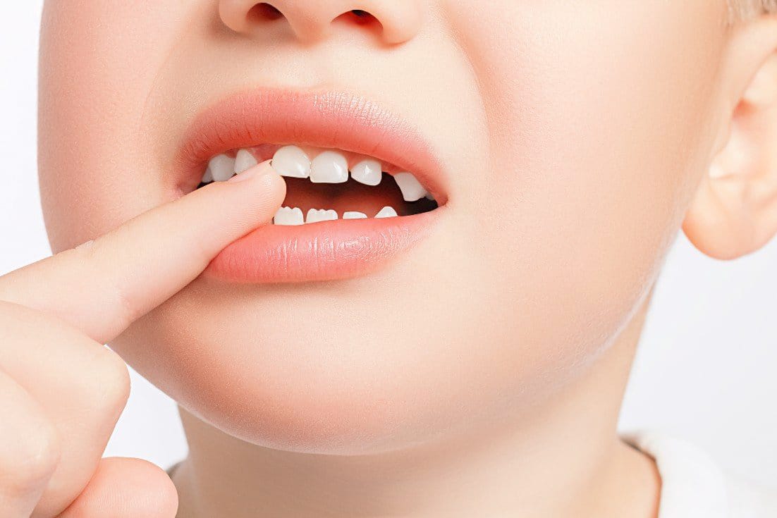 Vấn đề răng miệng cũng là nguyên nhân gây nhiệt miệng ở trẻ Vấn đề răng miệng cũng là nguyên nhân gây nhiệt miệng ở trẻ